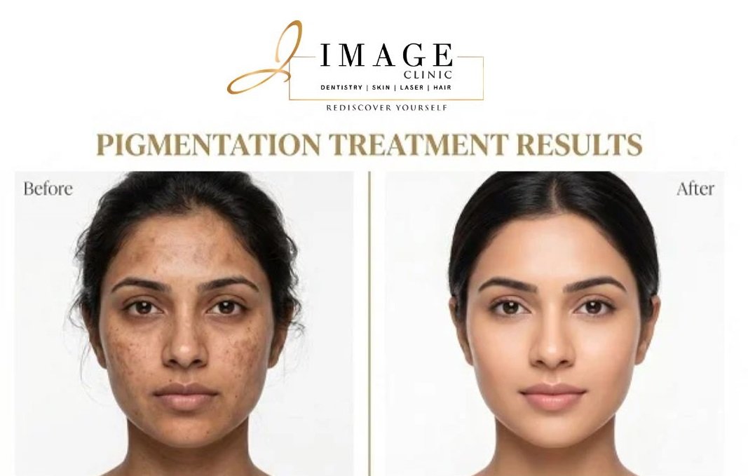 Pigmentation Treatment in Siliguri