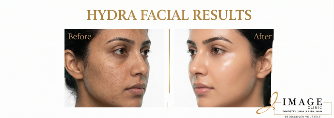 Hydra Facial in Siliguri
