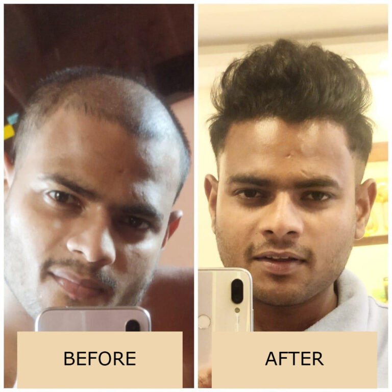 Best Hair Treatment In Kolkata | Hair Loss Treatment - 94337 06234