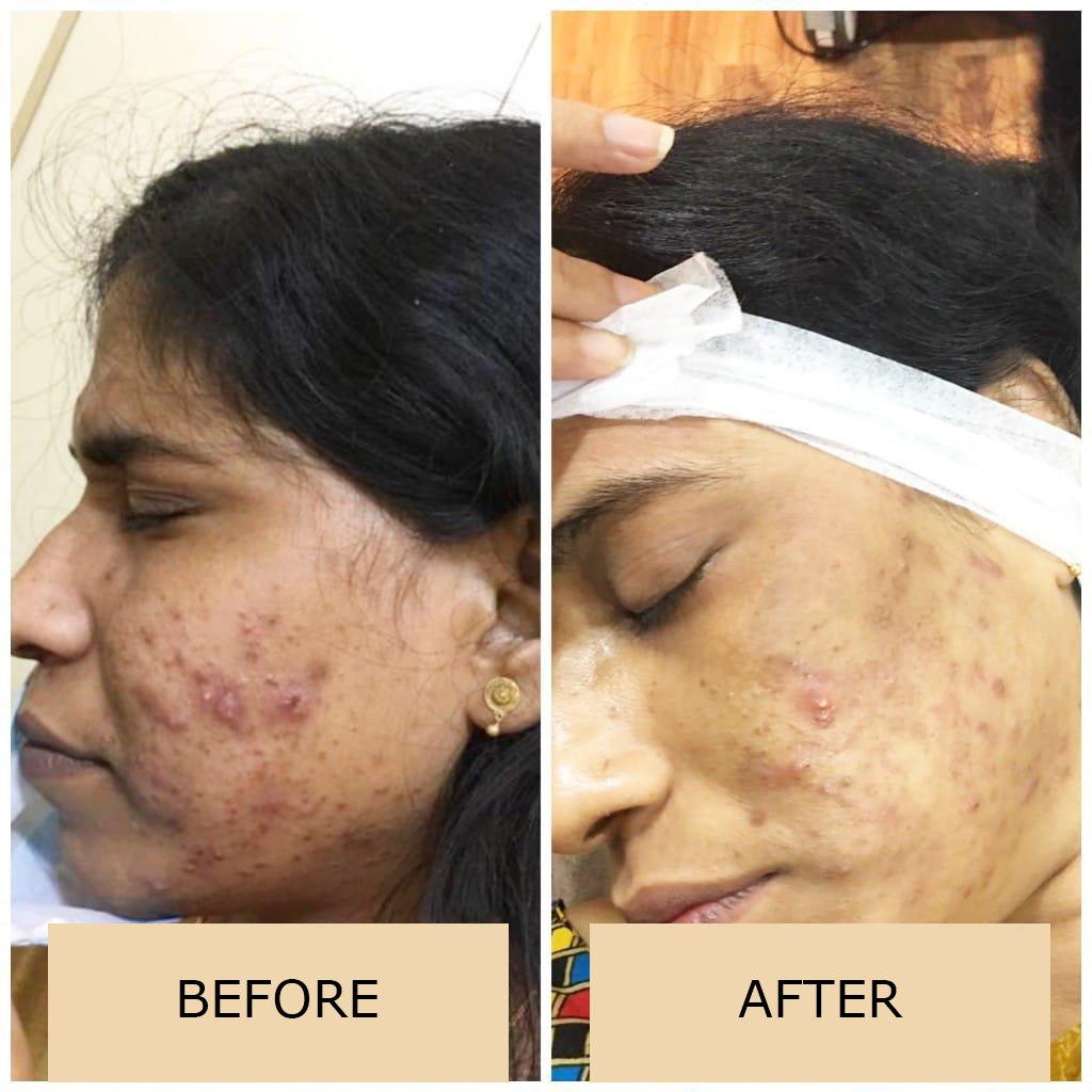 Best Skin Treatment In Kolkata Laser Treatment In Kolkata