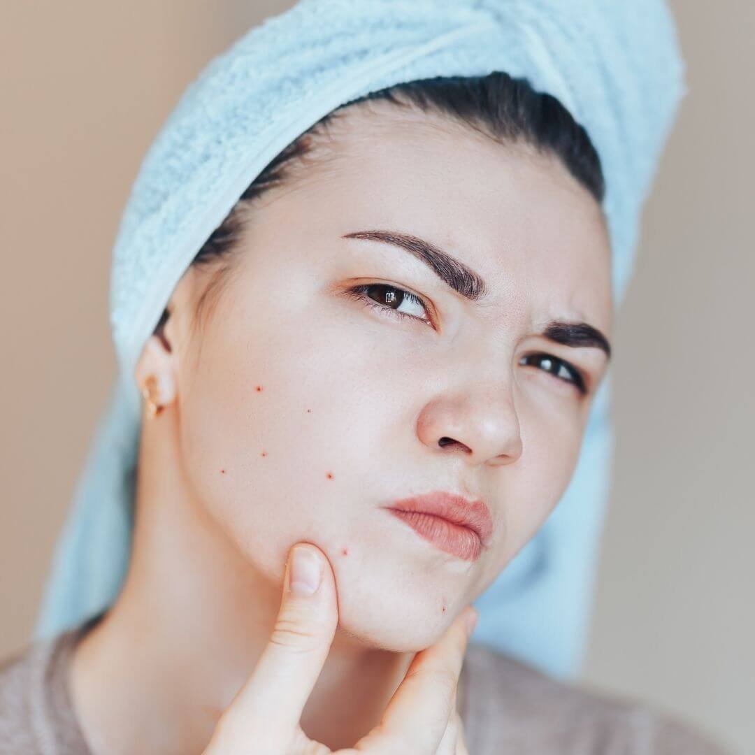 Acne Scars Removal Treatments