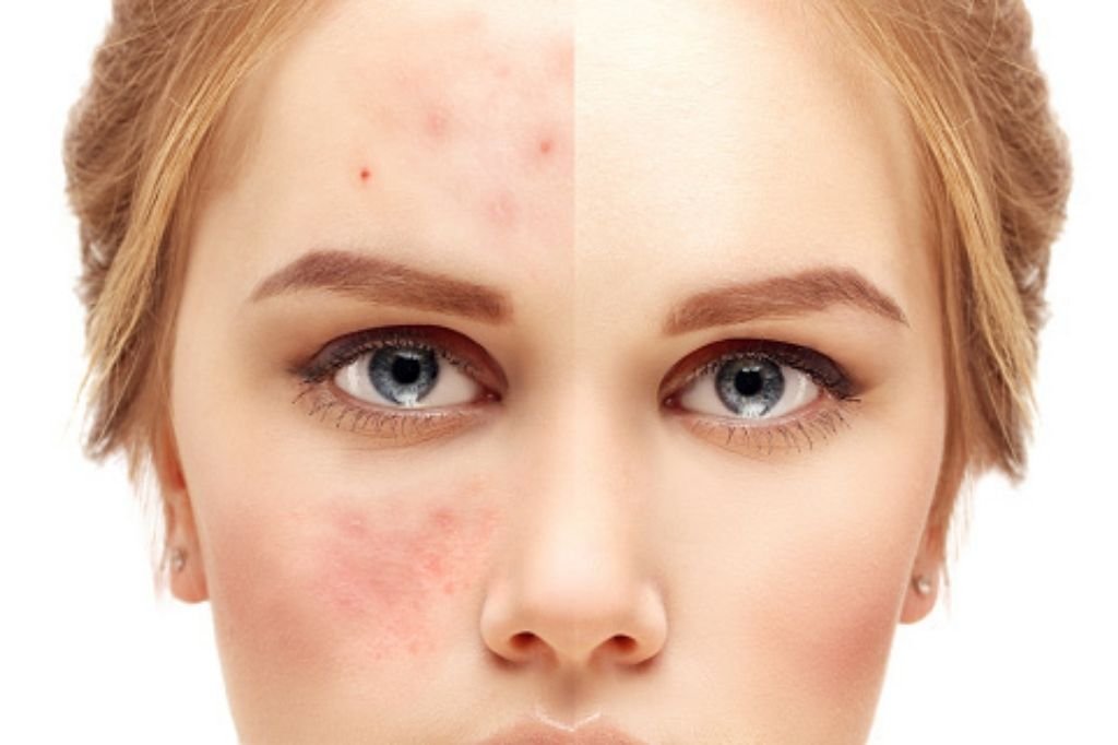 Skin Treatment for Acne Scars