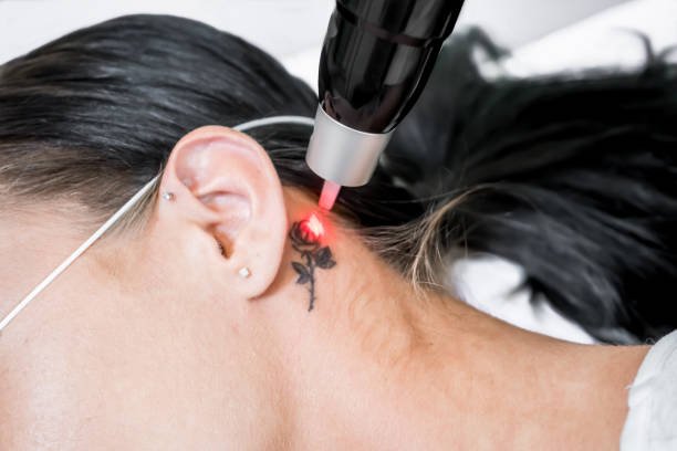 Q switched laser treatment