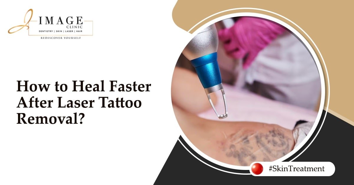 How to Heal Faster After Laser Tattoo Removal