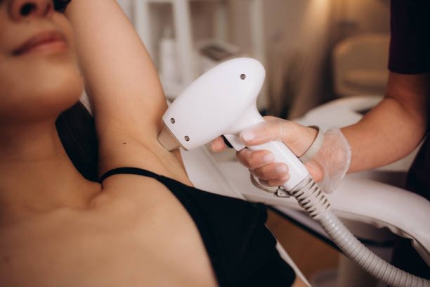 laser hair removal treatment