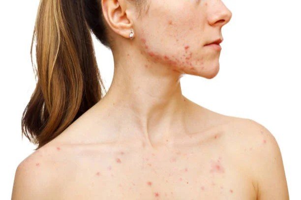 acne scar treatment in Kolkata