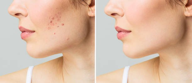 acne scar treatment in Kolkata