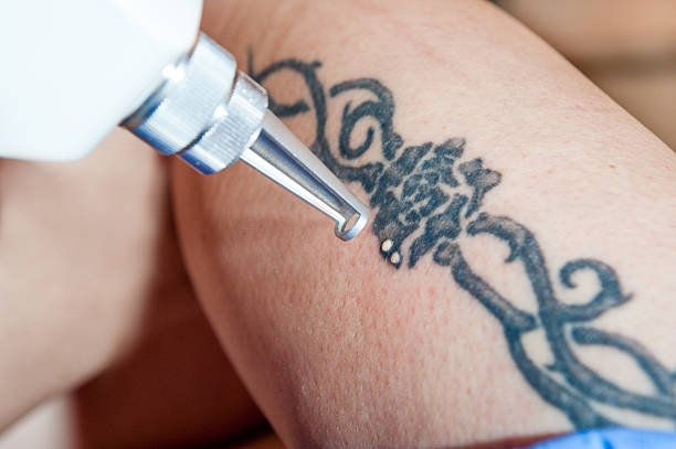laser tattoo removal