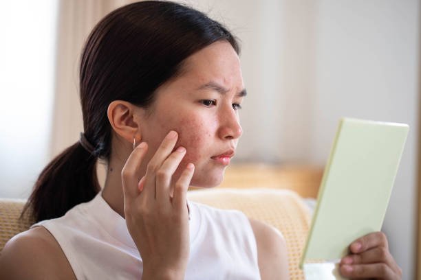 acne scars treatment