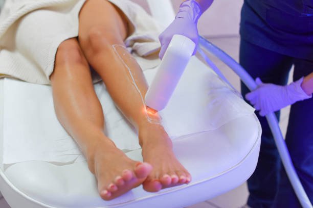laser treatment