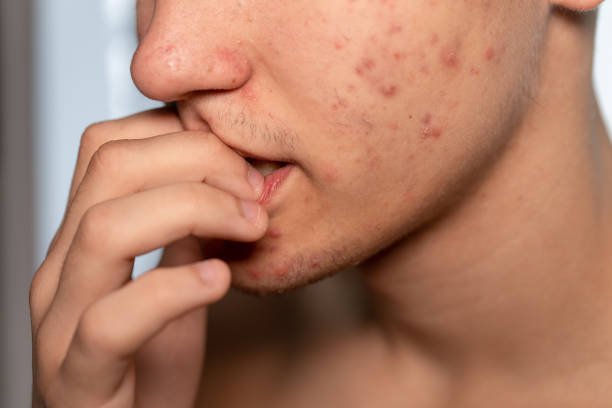 acne scars treatment