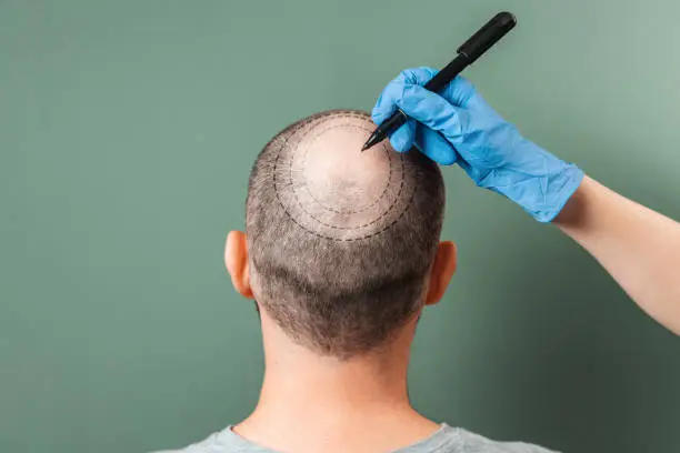 best-hair-transplant-clinic-in-kolkata