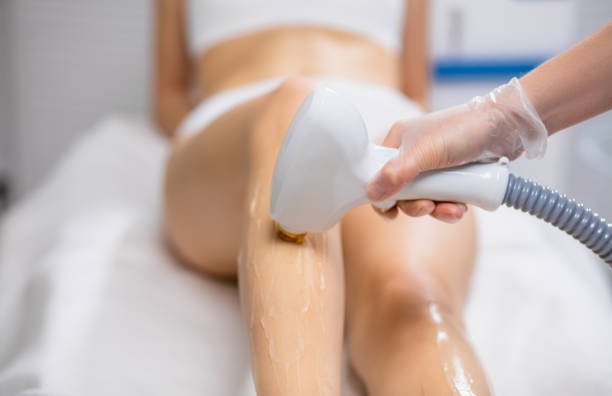 laser hair removal treatment