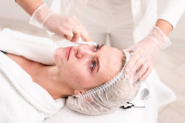 acne scars treatment in Kolkata