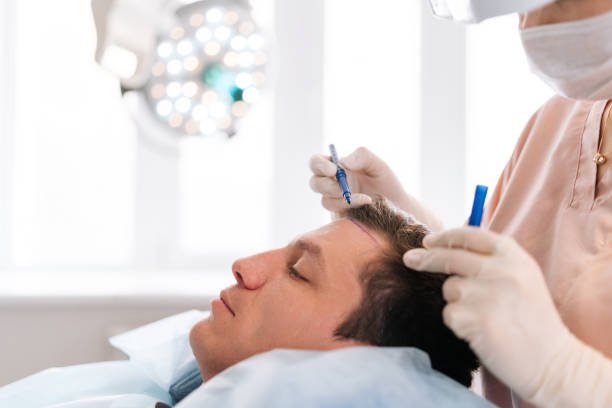 hair transplant