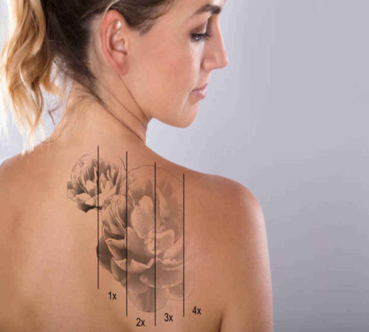 Laser Tattoo Removal in Kolkata