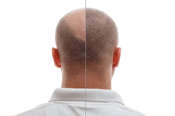 Effective-Hair-Transplants-in-Kolkata