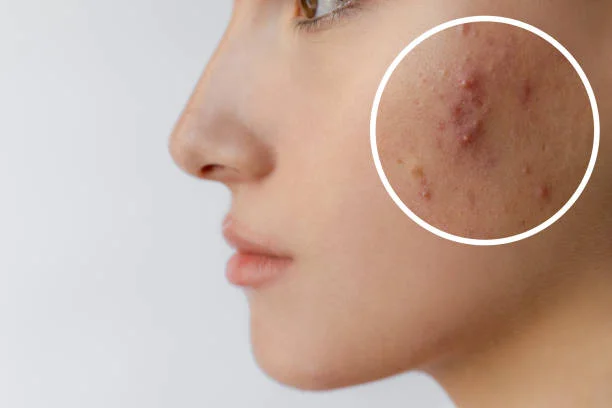 acne-treatment-in-kolkata