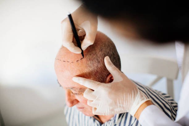 best hair transplant clinic