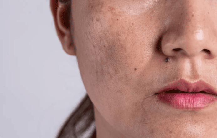 Pigmentation Treatments