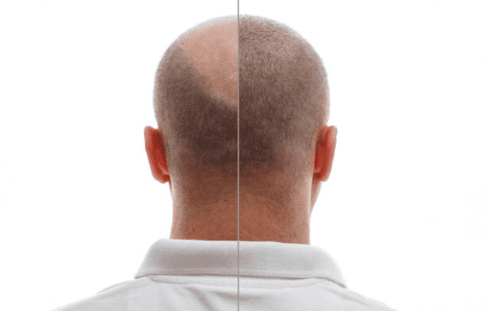Hair Loss Problem