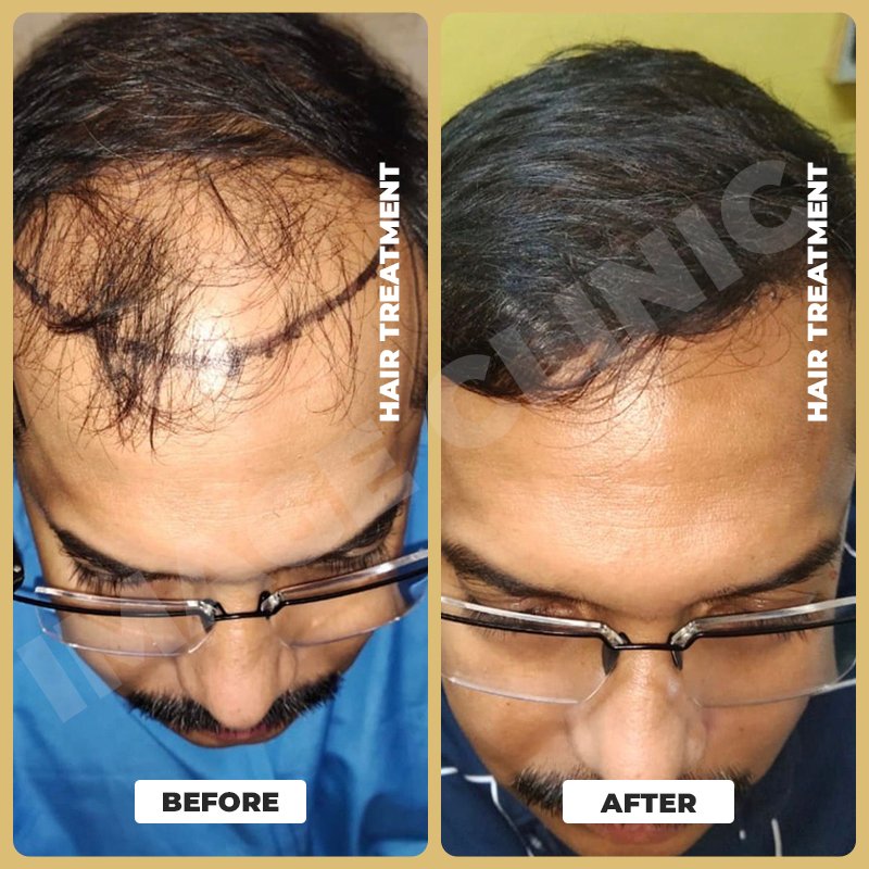 Hair Treatment