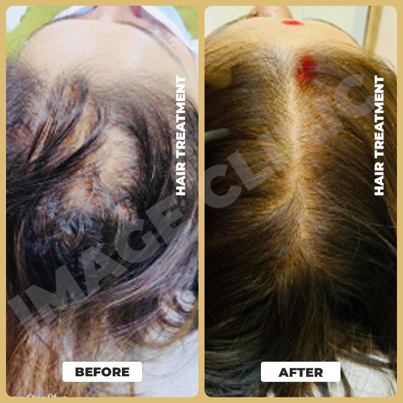 Hair Treatment