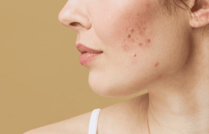 acne scars