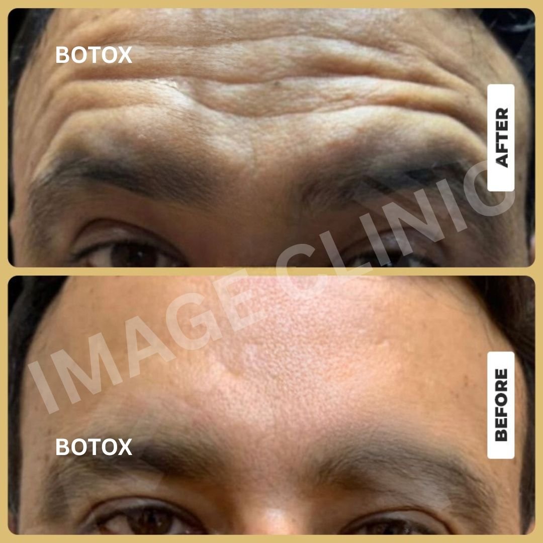 Botox- 1