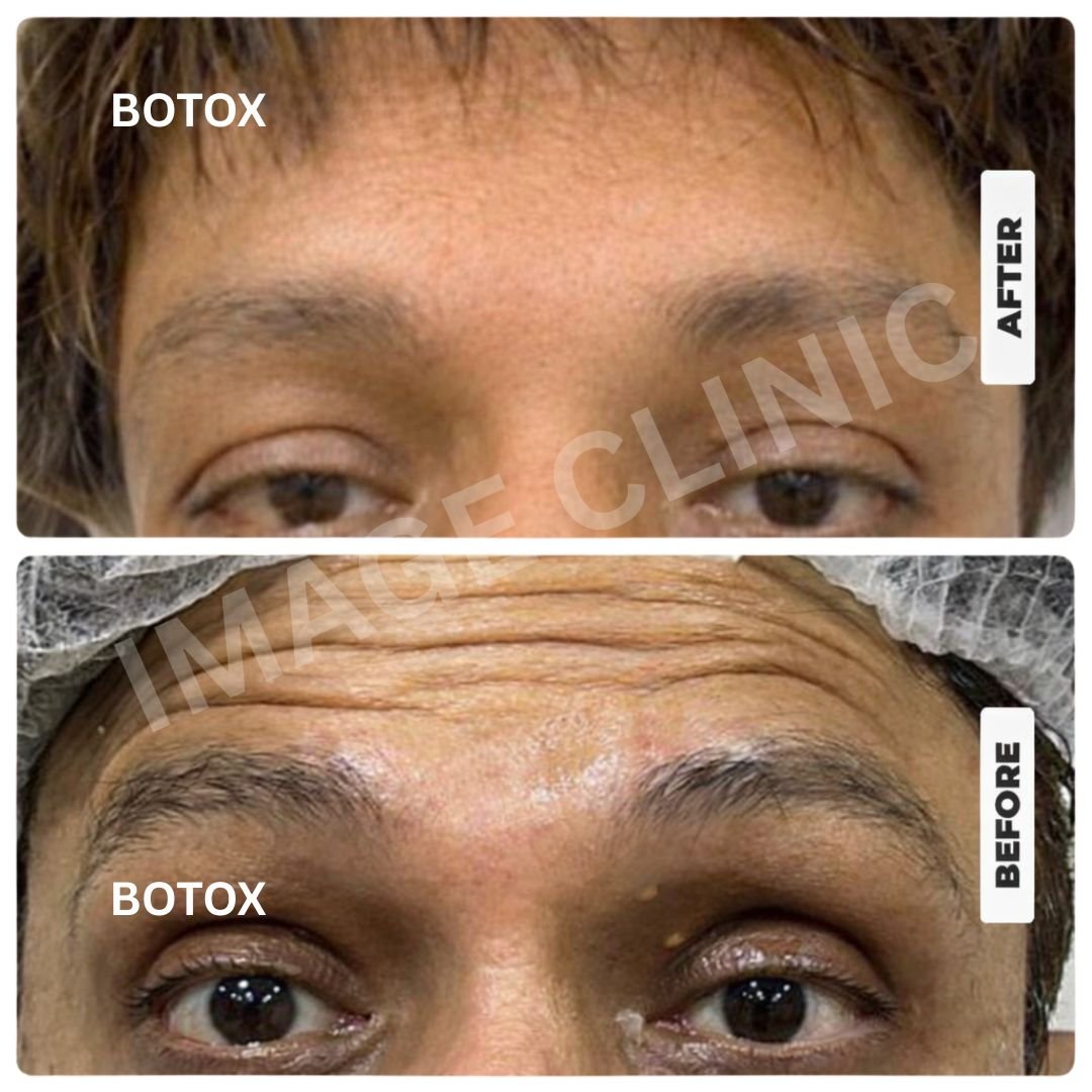Botox