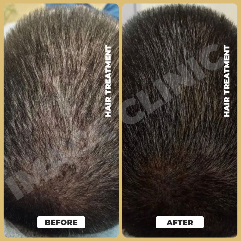 Hair Treatment-3.jpg