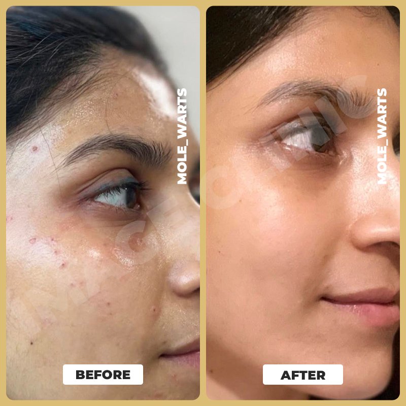 Mole _ Warts-1.jpg