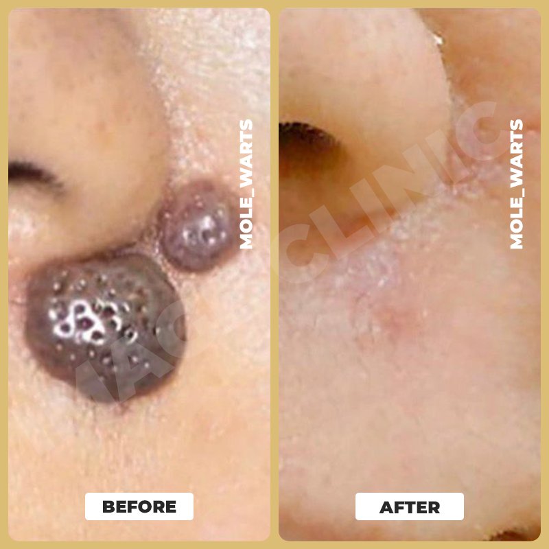 Mole _ Warts-3.jpg