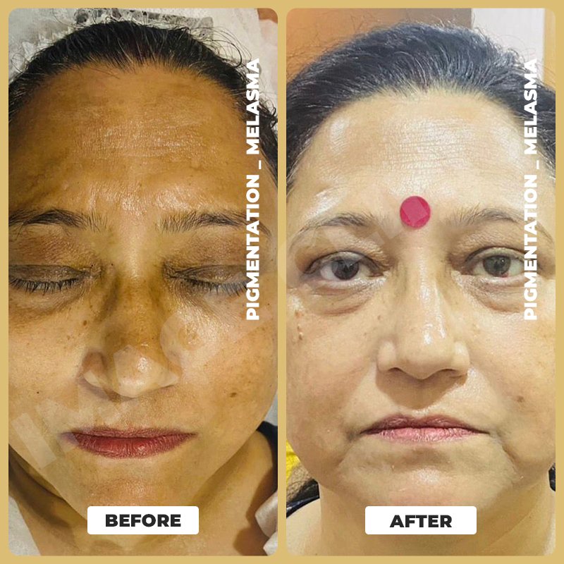 Pigmentation _ Melasma-7.jpg