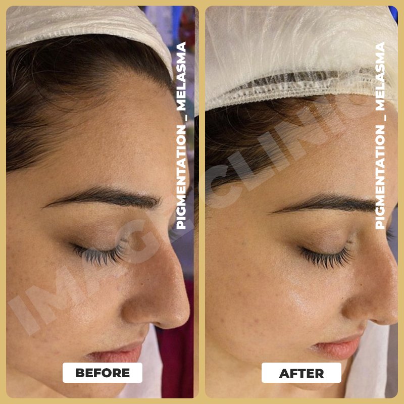 Pigmentation _ Melasma-8.jpg