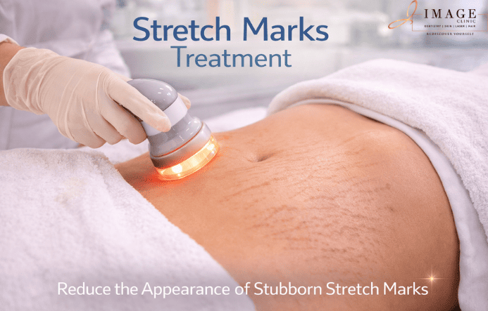 Stretch Marks Treatment