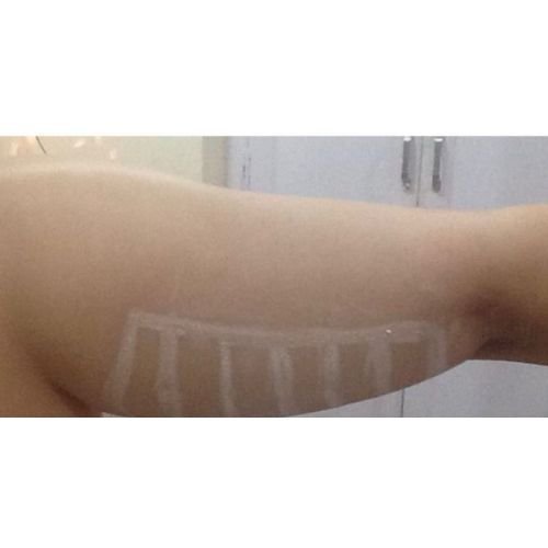 HIFU Treatment Siliguri