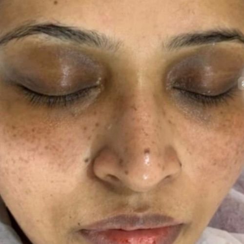 Pigmentation Treatment