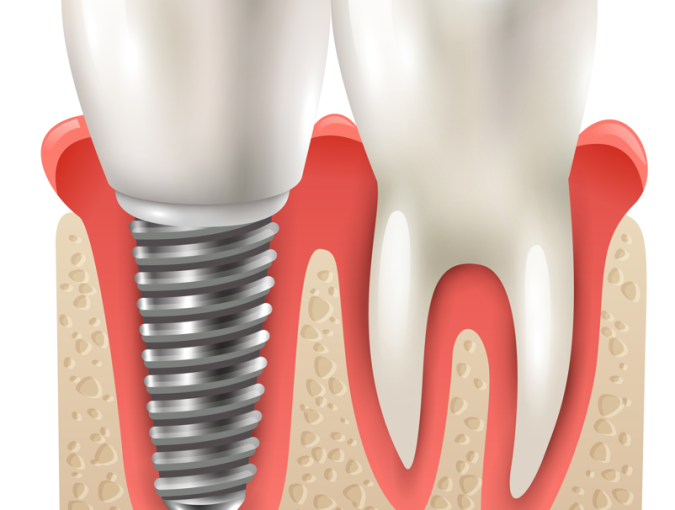 Dental Implants