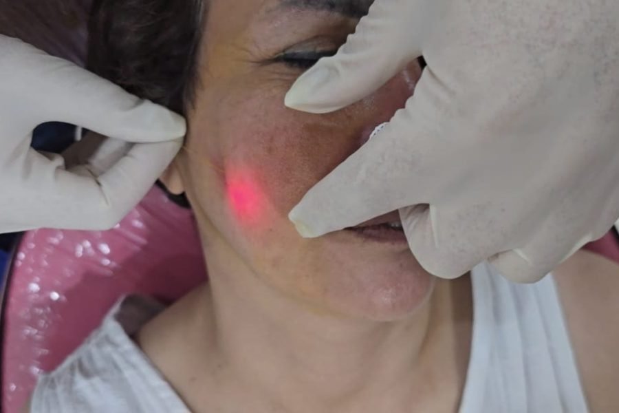 Endolift-Before-After