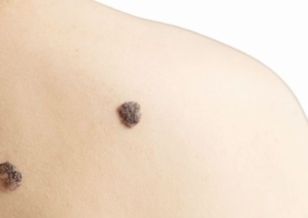 Moles Removal- DP.jpg