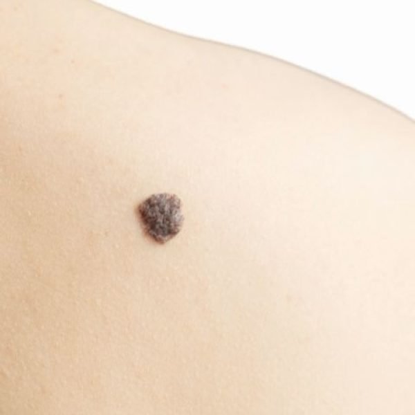 Moles Removal- DP.jpg