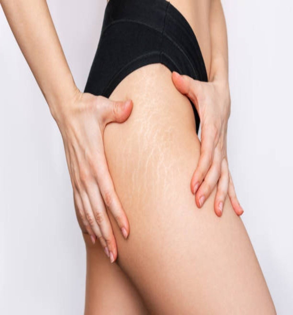 Stretch Mark Reduction Stretch Mark Reduction
