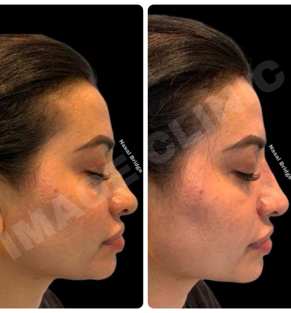 acne scar treatment Acne Treatments