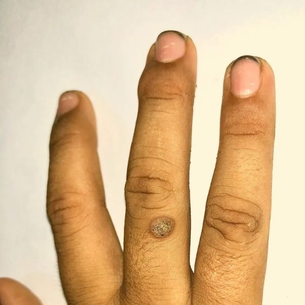 warts Treatment - MV.jpg